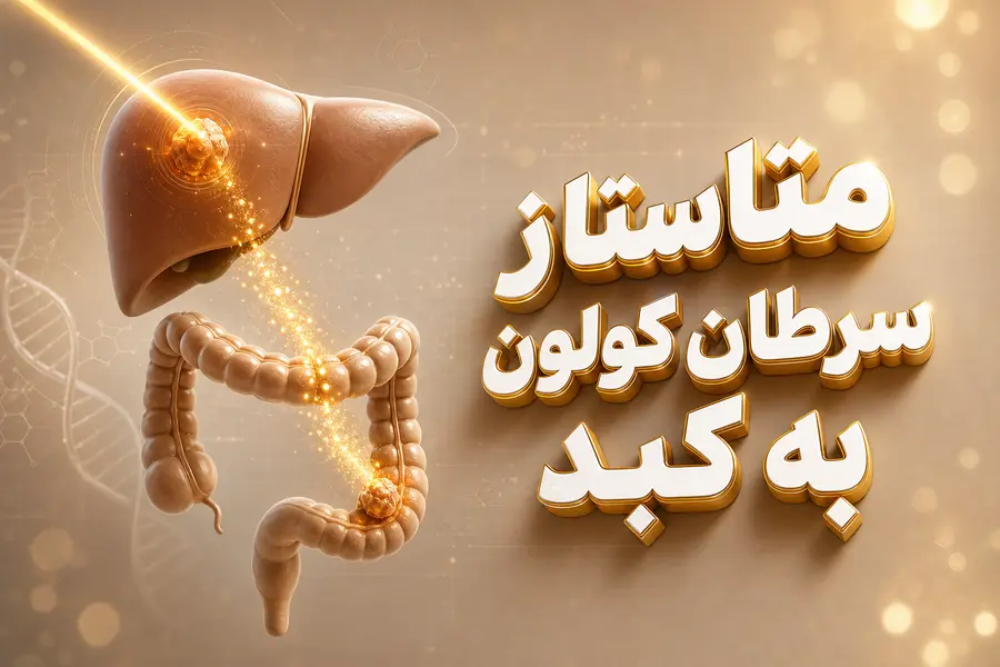 متاستاز سرطان کولون به کبد | روش‌های درمان سرطان کولون با متاستاز کبدی