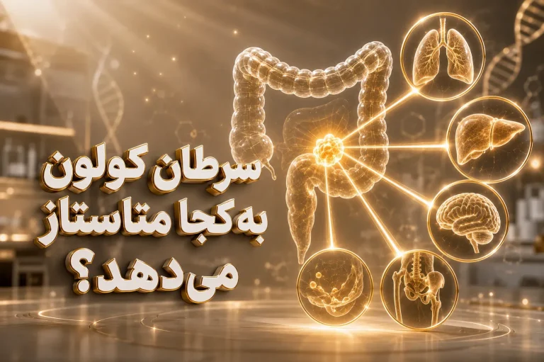 متاستاز سرطان کولون؛ سرطان کولون به کجا متاستاز می‌دهد؟